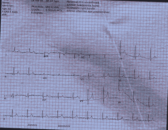 Normal ECG — PTB-XL