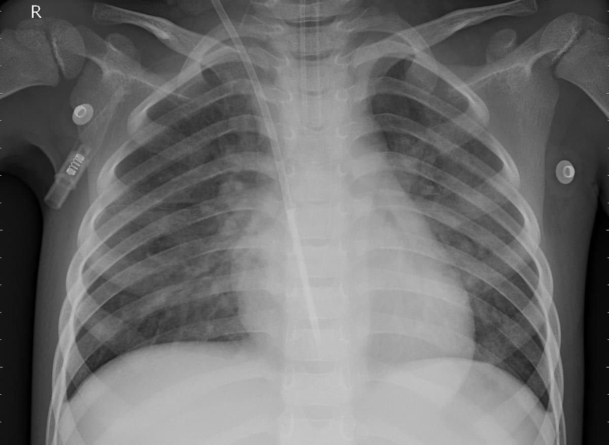 Pneumonia — NIH Chest X-ray14