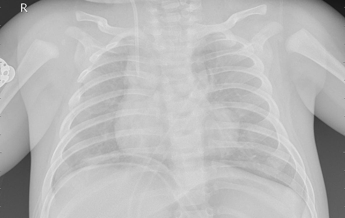Pneumonia — NIH Chest X-ray14