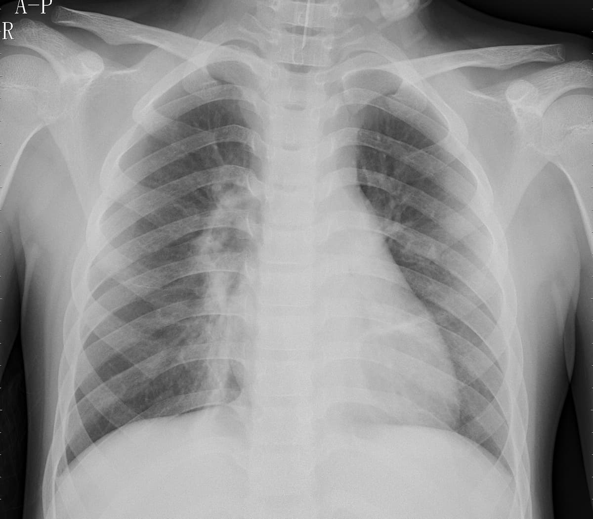 Pneumonia — NIH Chest X-ray14