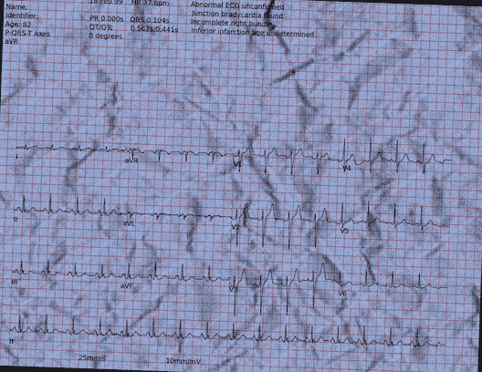 Normal ECG — PTB-XL