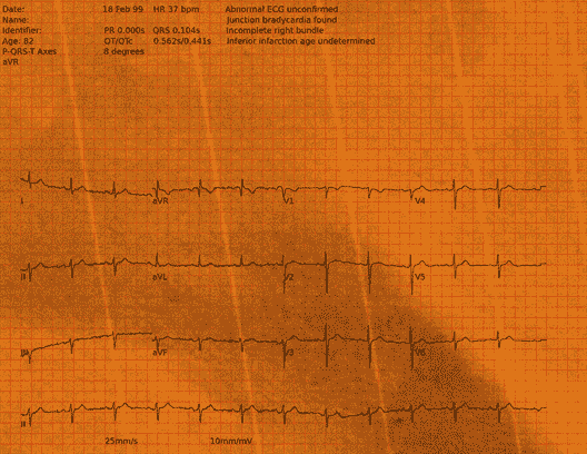 Normal ECG — PTB-XL