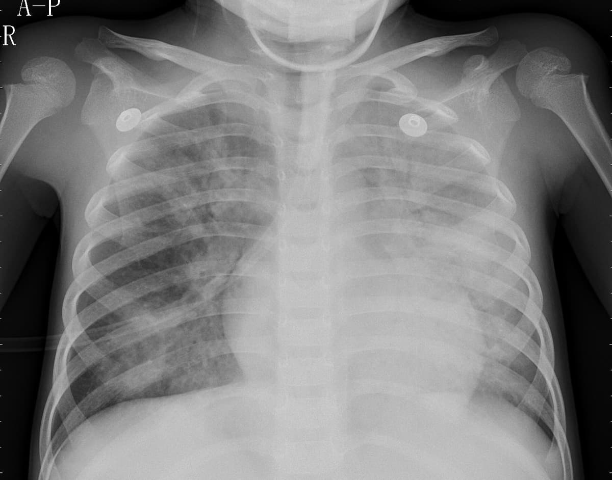 Pneumonia — NIH Chest X-ray14