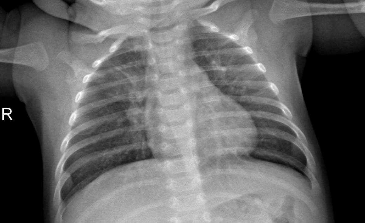 Pneumonia — NIH Chest X-ray14