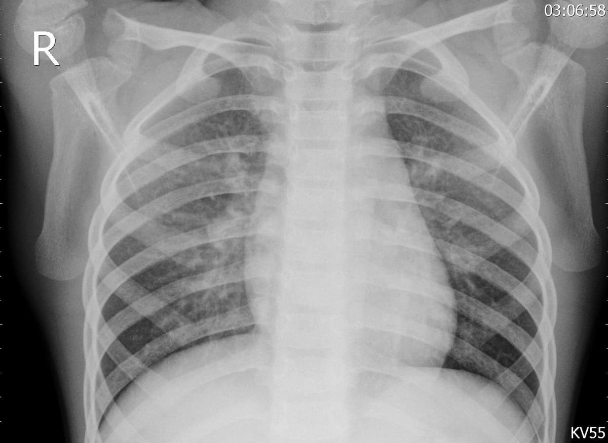 Pneumonia — NIH Chest X-ray14