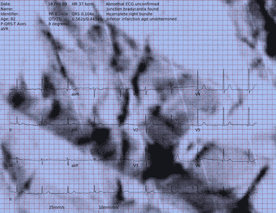 Normal ECG — PTB-XL