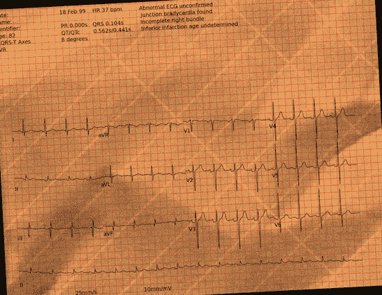 Normal ECG — PTB-XL