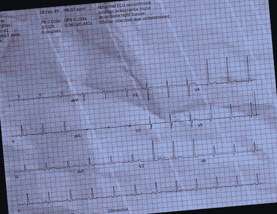Normal ECG — PTB-XL