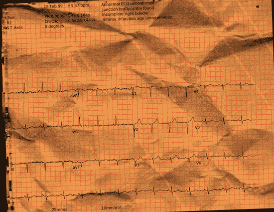 Normal ECG — PTB-XL
