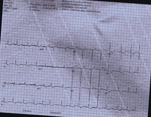 Normal ECG — PTB-XL