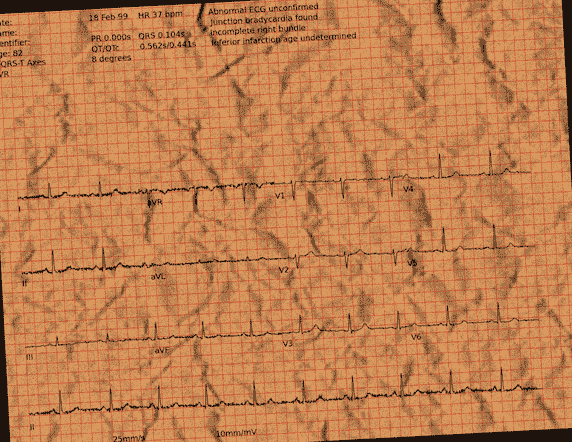 Normal ECG — PTB-XL