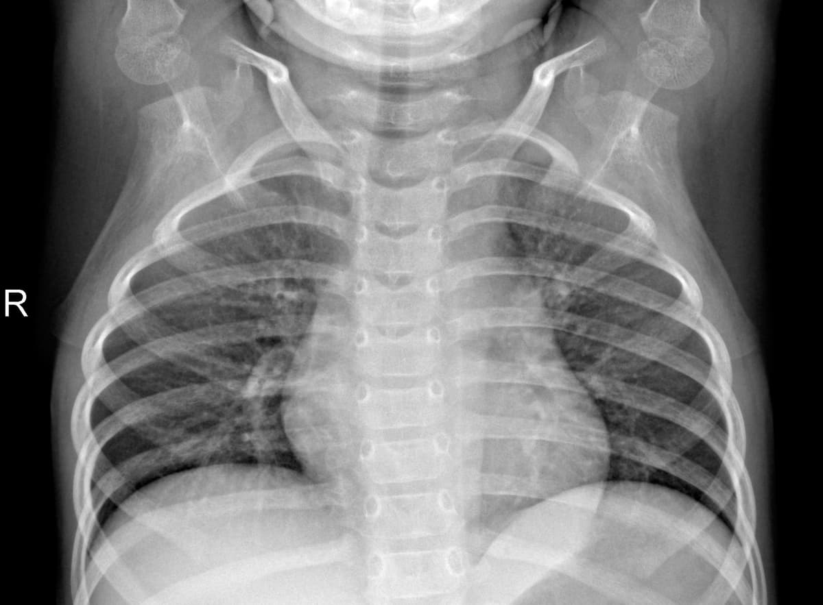 Radiografia Normal — NIH Chest X-ray14