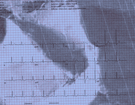 Normal ECG — PTB-XL