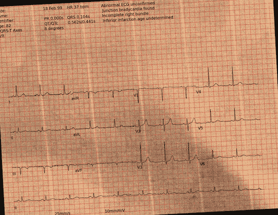 Normal ECG — PTB-XL