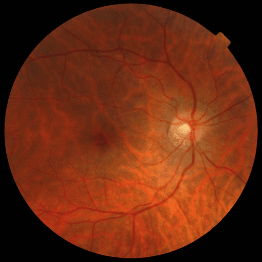 No Diabetic Retinopathy — MESSIDOR-2