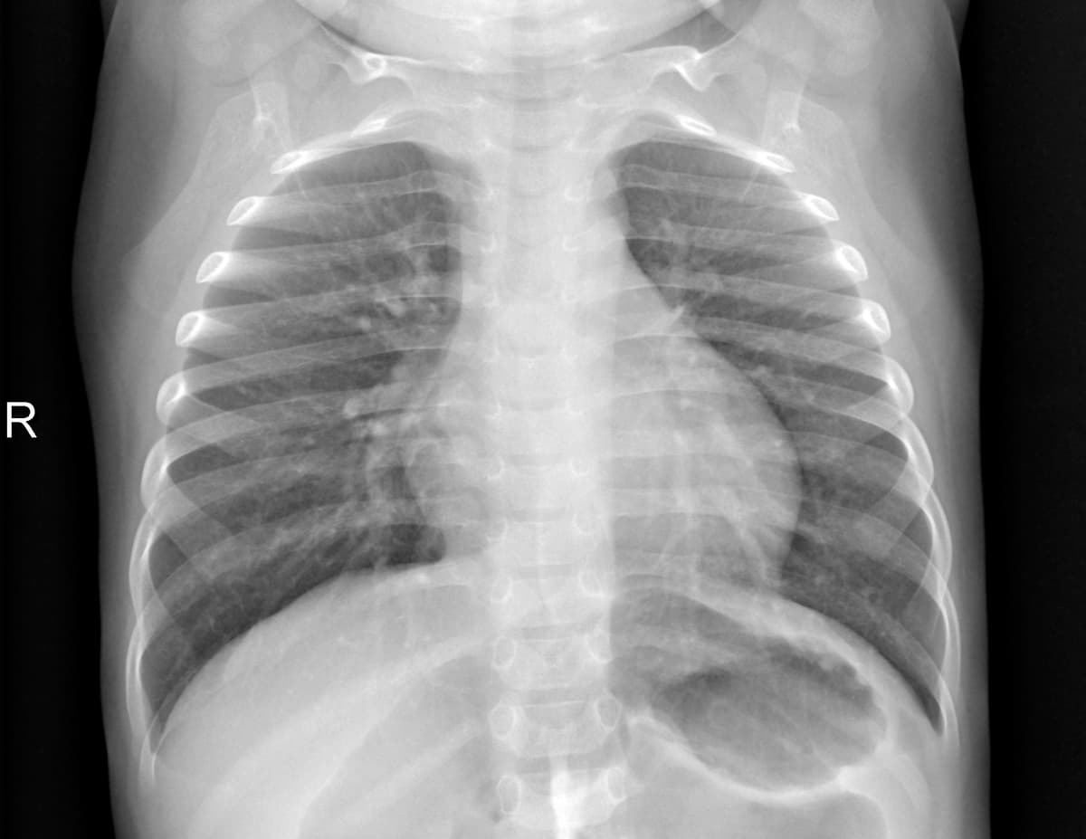 Radiografia Normal — NIH Chest X-ray14
