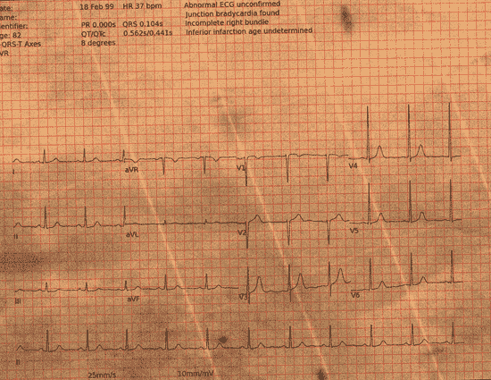 Normal ECG — PTB-XL
