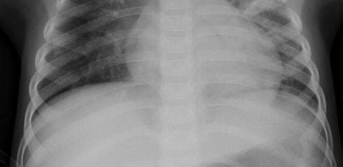 Pneumonia — NIH Chest X-ray14