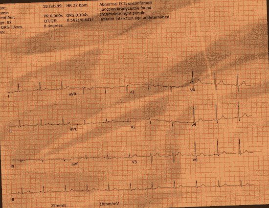 Normal ECG — PTB-XL