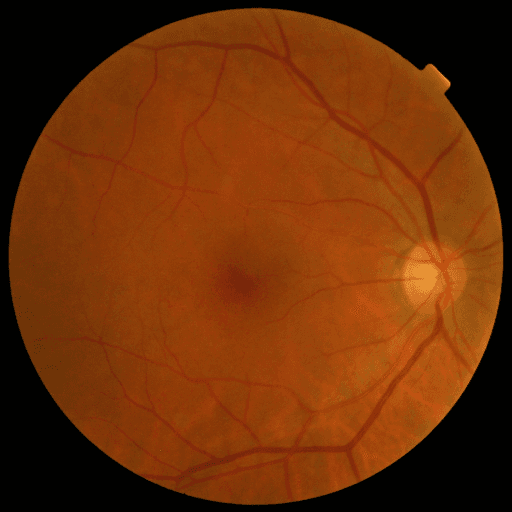 Proliferative DR — MESSIDOR-2