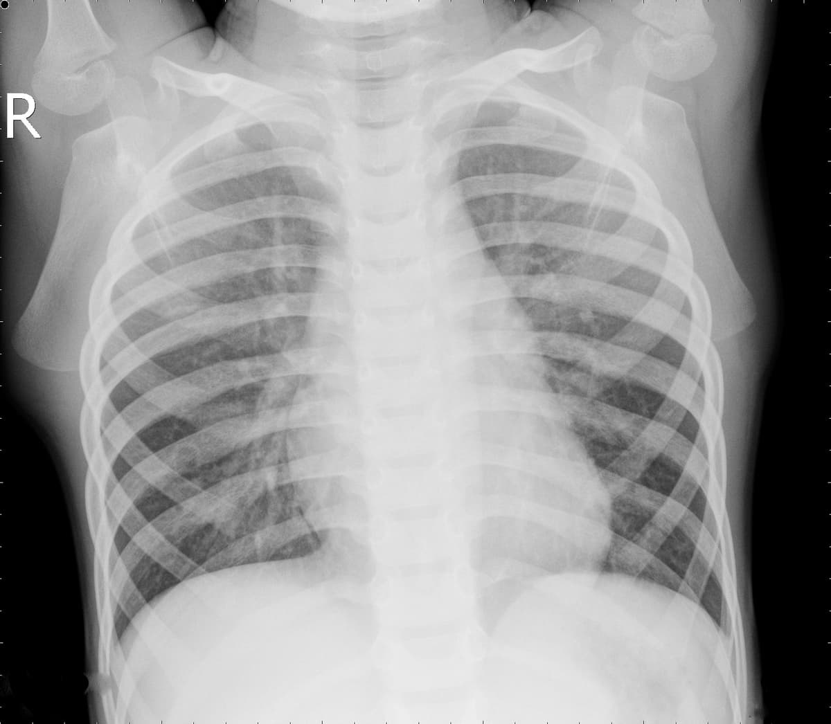 Radiografia Normal — NIH Chest X-ray14