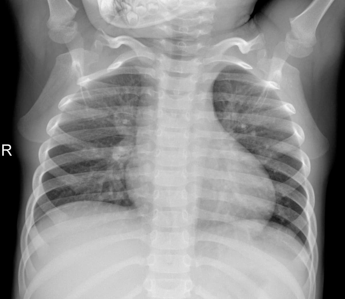 Radiografia Normal — NIH Chest X-ray14