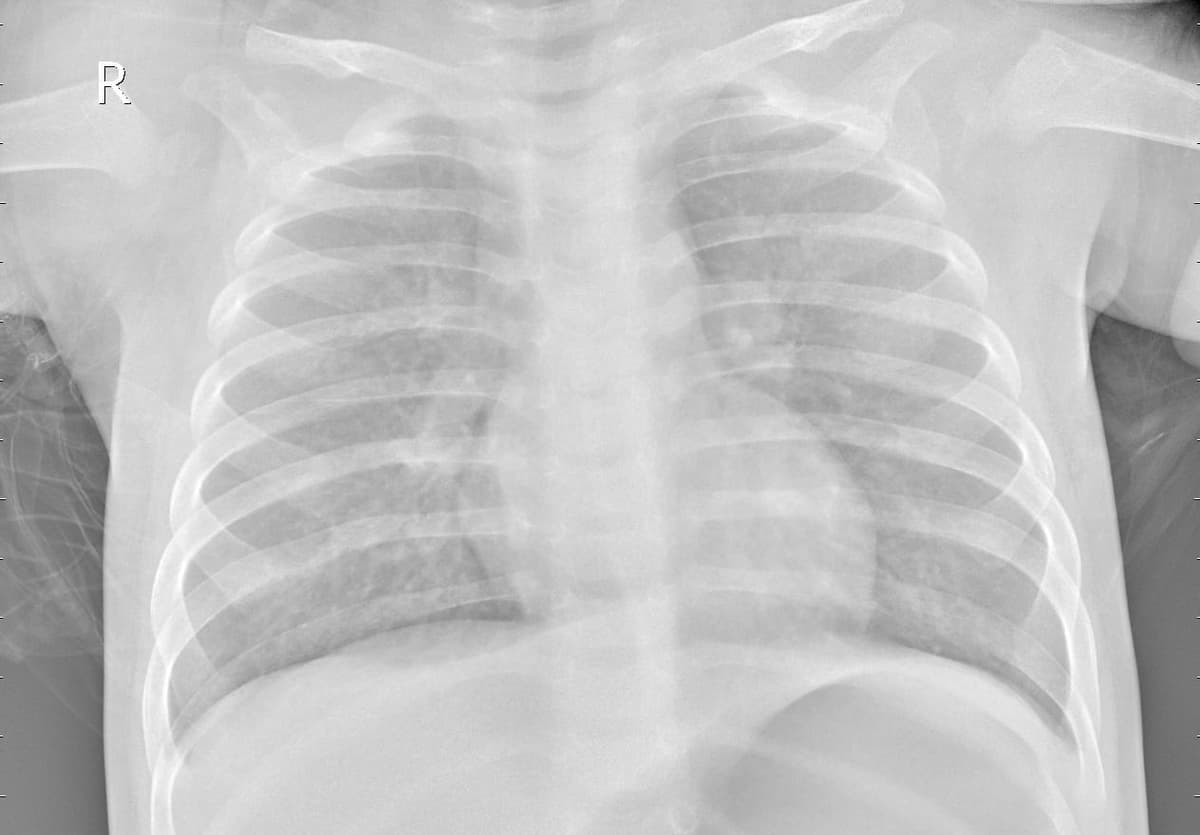 Pneumonia — NIH Chest X-ray14