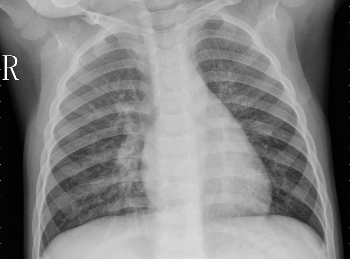 Pneumonia — NIH Chest X-ray14