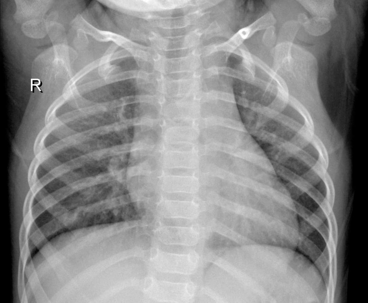 Radiografia Normal — NIH Chest X-ray14
