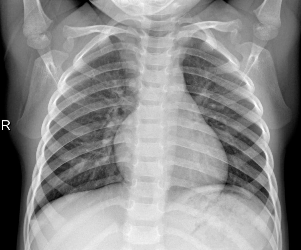 Radiografia Normal — NIH Chest X-ray14