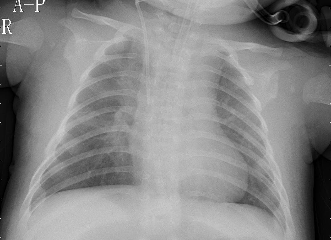 Pneumonia — NIH Chest X-ray14