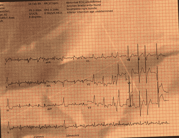 Normal ECG — PTB-XL