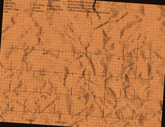 Normal ECG — PTB-XL