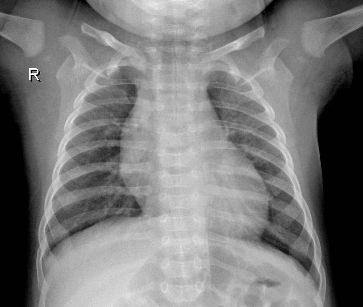 Radiografia Normal — NIH Chest X-ray14