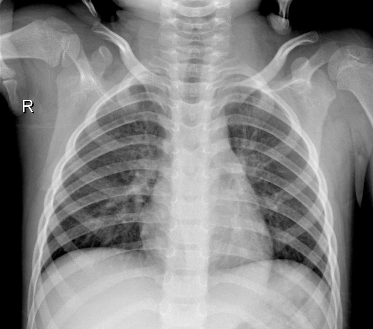 Radiografia Normal — NIH Chest X-ray14