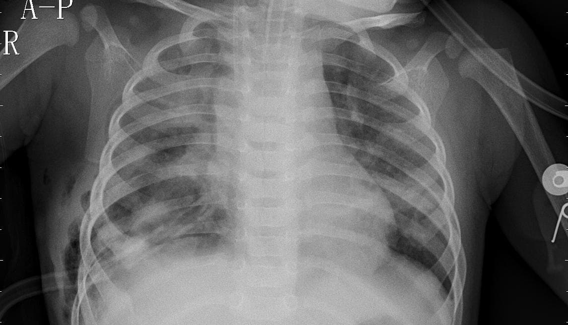 Pneumonia — NIH Chest X-ray14