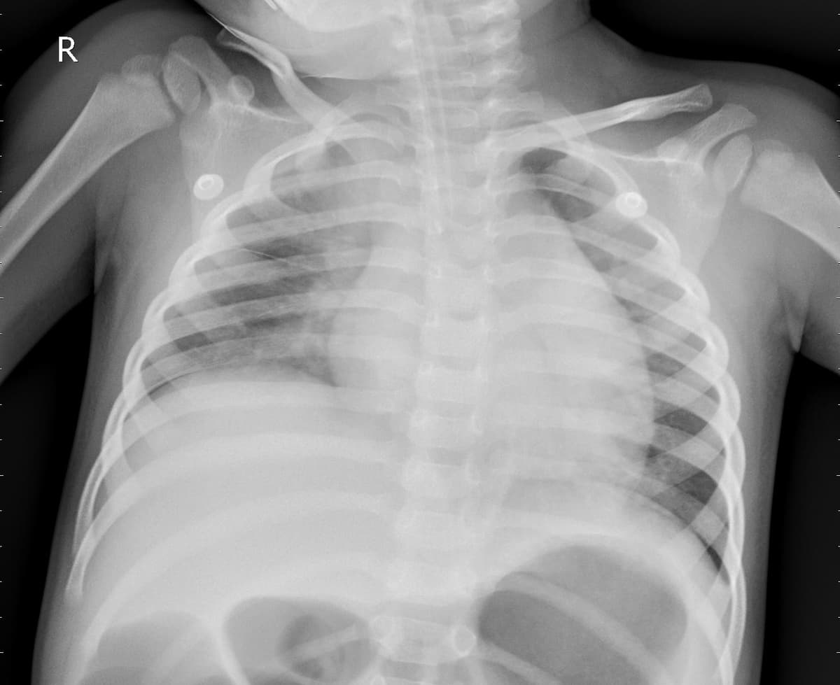 Pneumonia — NIH Chest X-ray14