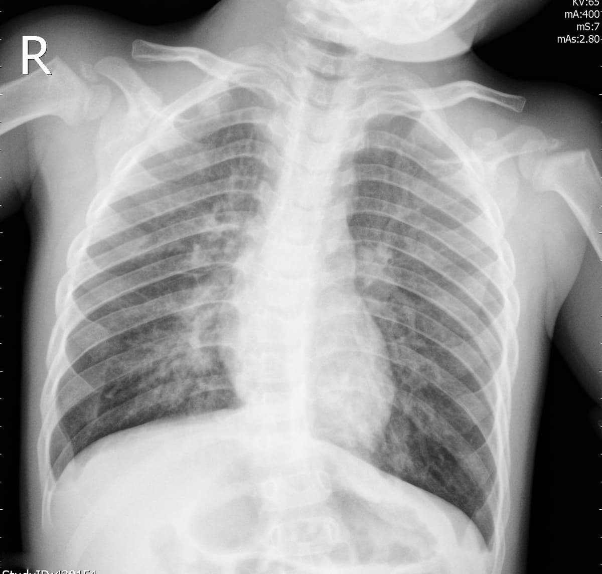 Pneumonia — NIH Chest X-ray14