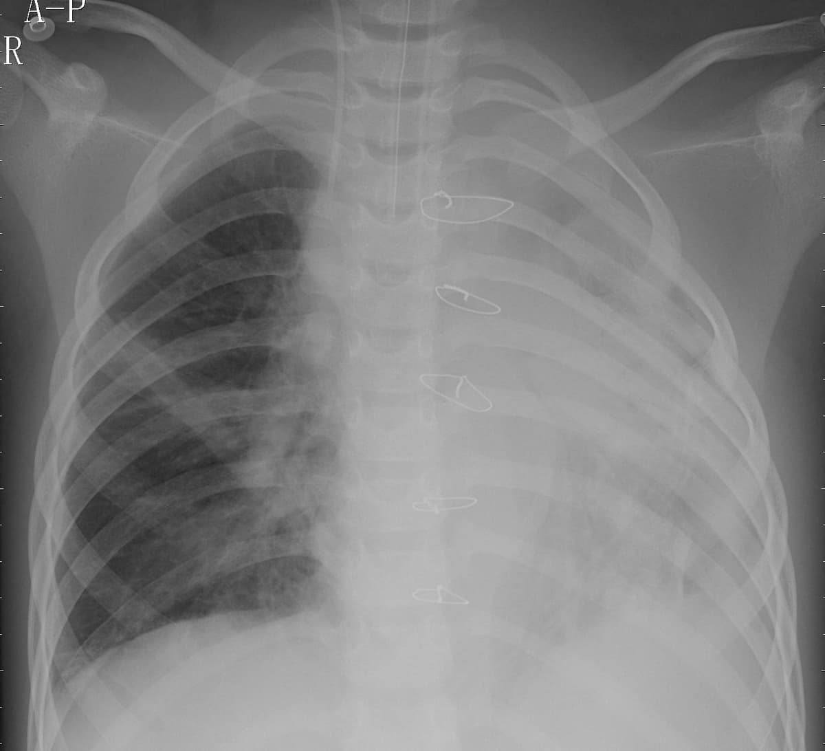Pneumonia — NIH Chest X-ray14