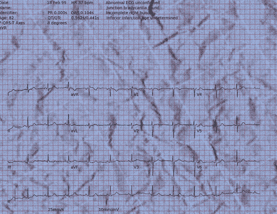 Normal ECG — PTB-XL