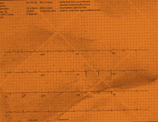 Normal ECG — PTB-XL