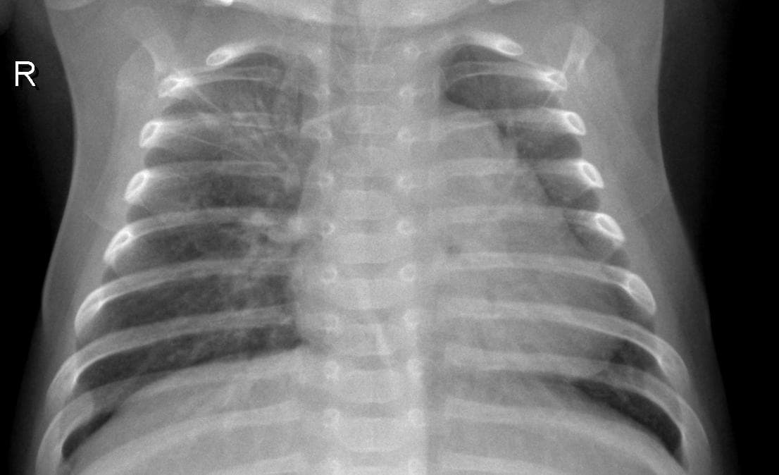 Pneumonia — NIH Chest X-ray14
