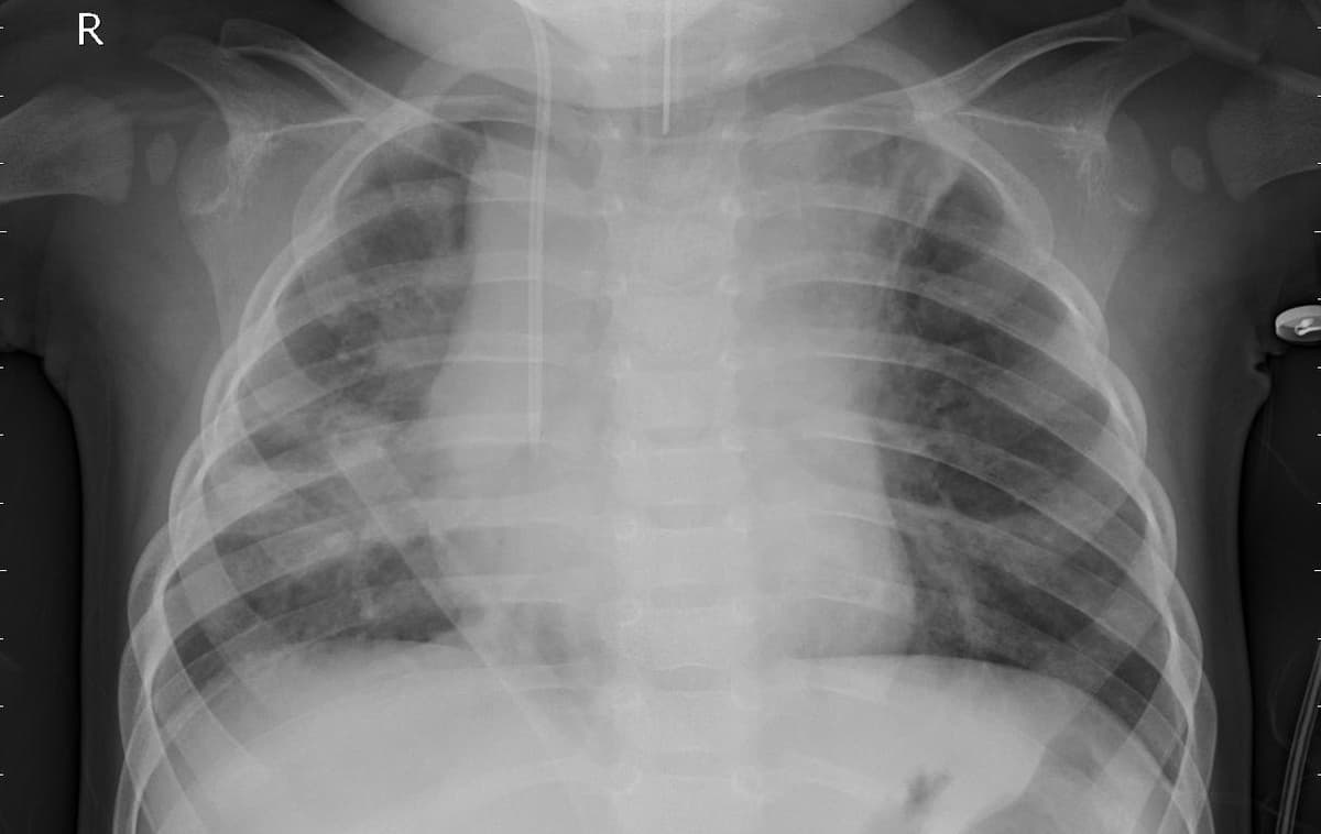 Pneumonia — NIH Chest X-ray14