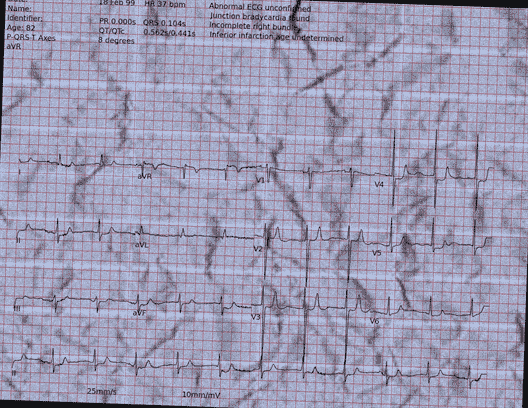 Normal ECG — PTB-XL
