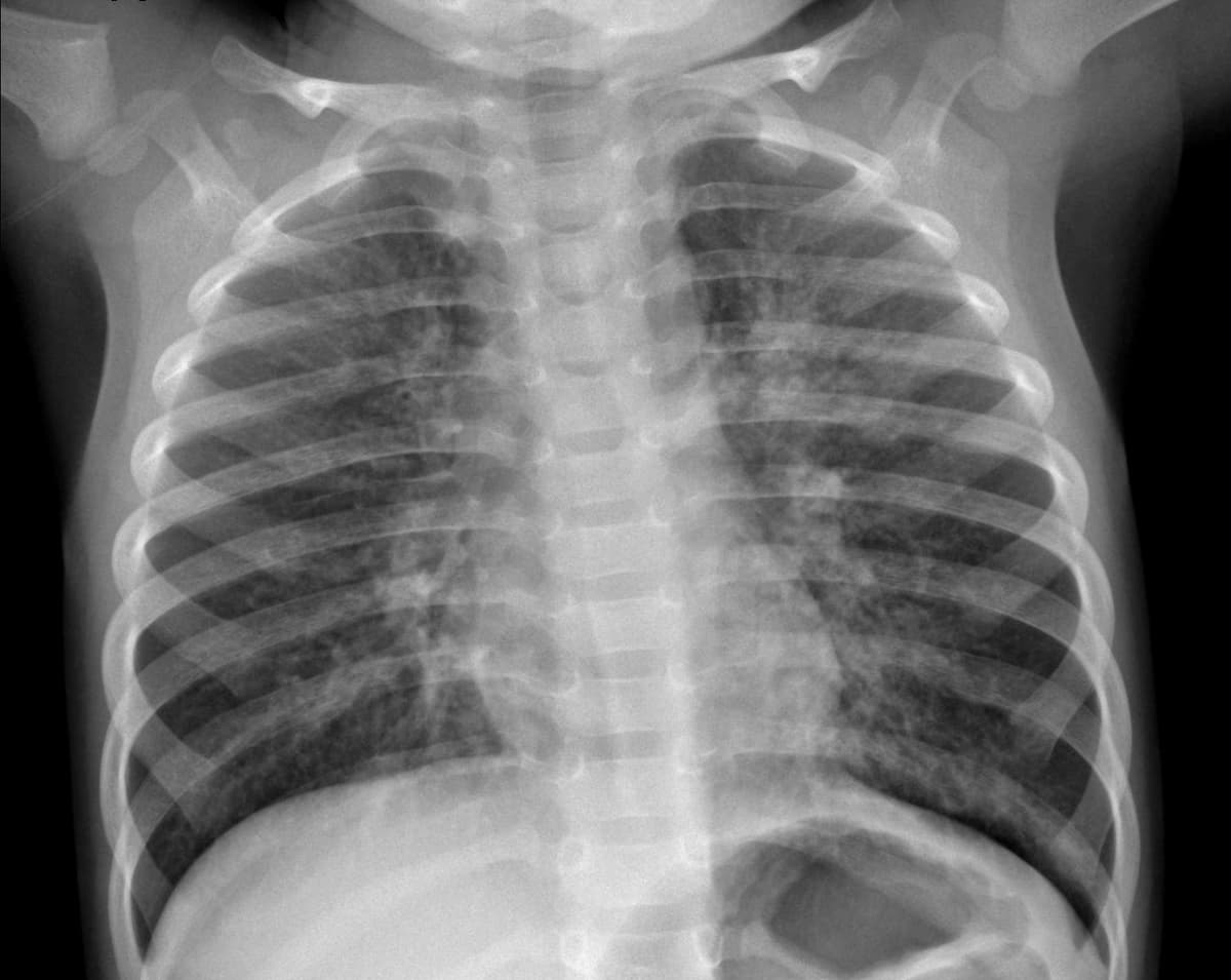 Pneumonia — NIH Chest X-ray14
