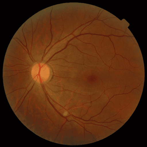 No Diabetic Retinopathy — MESSIDOR-2
