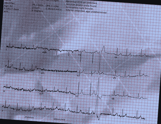 Normal ECG — PTB-XL