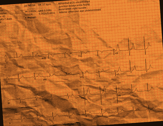 Normal ECG — PTB-XL