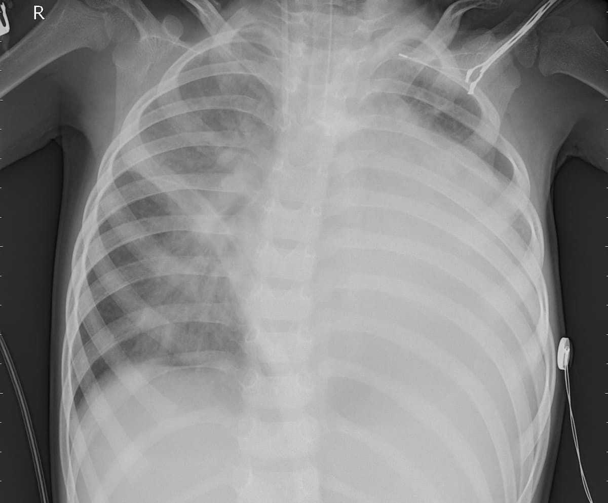 Pneumonia — NIH Chest X-ray14
