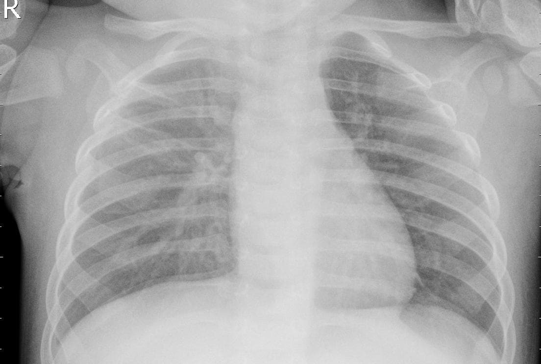 Pneumonia — NIH Chest X-ray14